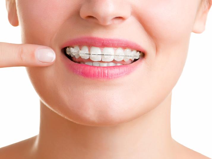 Calgary Adult Orthodontics | North Calgary Orthodontics | Orthodontist Calgary