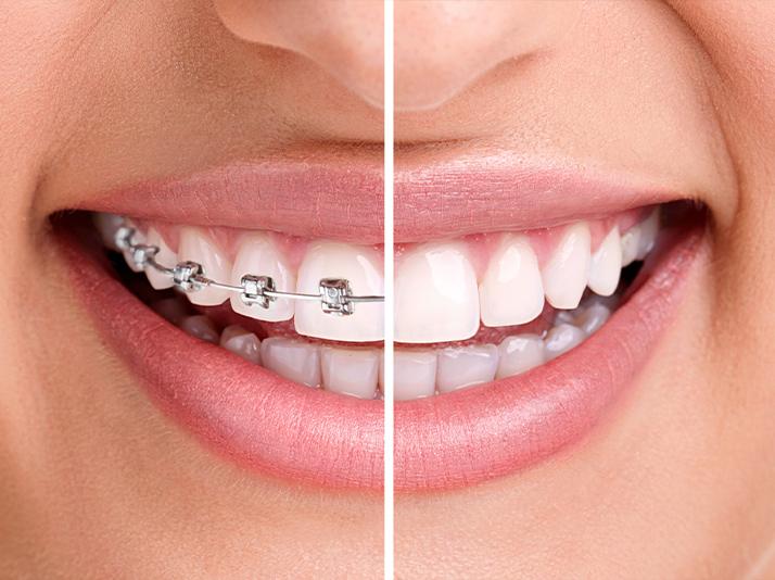 Adult Orthodontics NW Calgary | North Calgary Orthodontics | Orthodontist Calgary