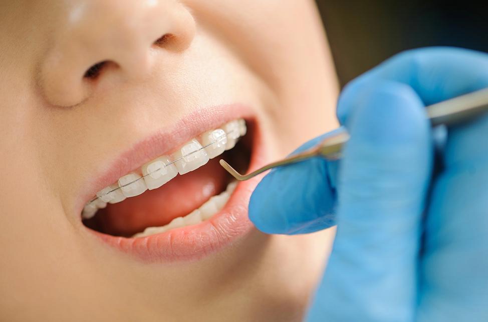 Ceramic Braces | North Calgary Orthodontics | Orthodontist Calgary
