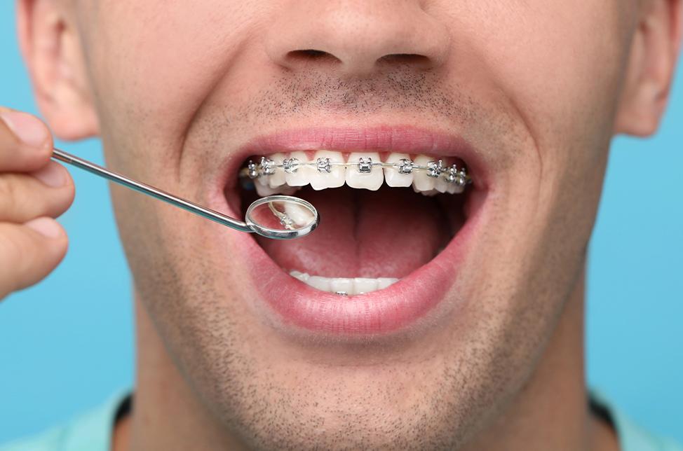 Metal Braces | North Calgary Orthodontics | Orthodontist NW Calgary