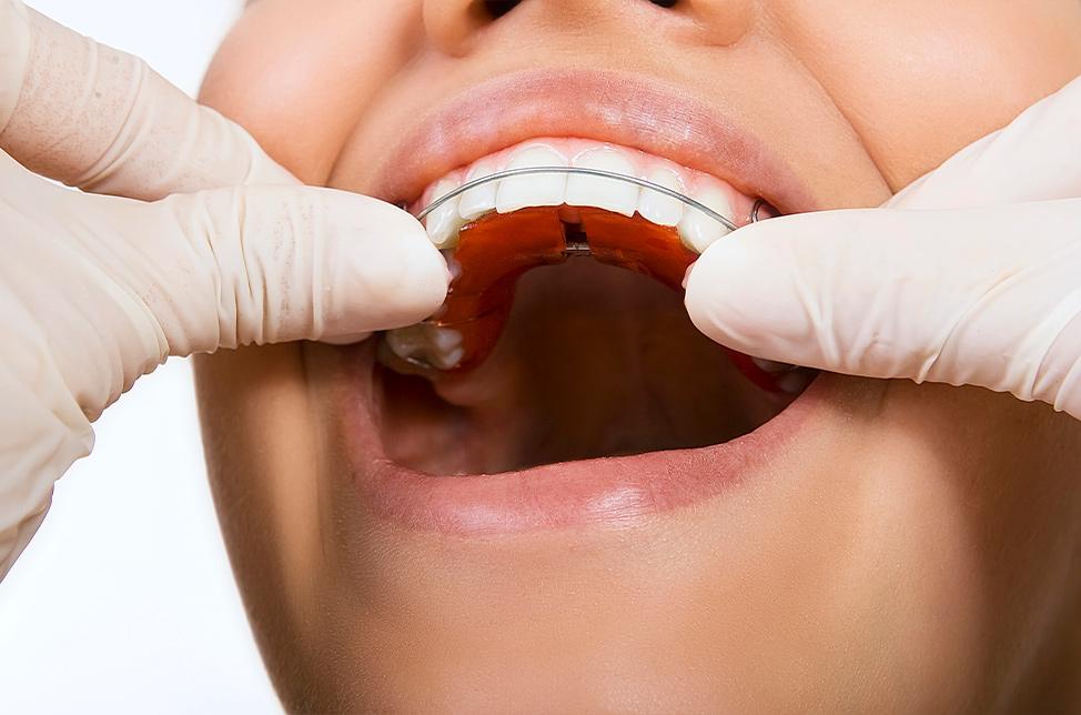 Reatainers and Post Treatment Care | North Calgary Orthodontics | Calgary Orthodontist
