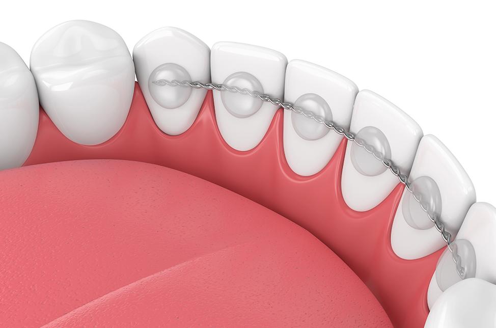 How Long Should You Wear Retainers | North Calgary Orthodontics | Orthodontist Calgary