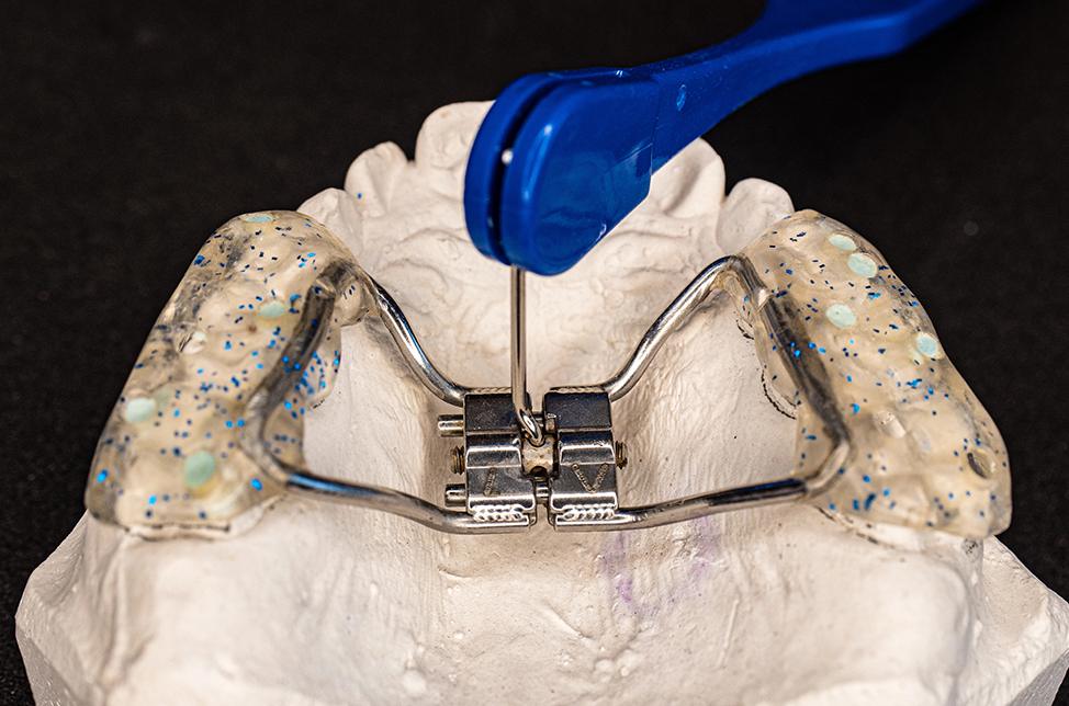 Permanent Retainer NW Calgary | North Calgary Orthodontics | Orthodontist Calgary