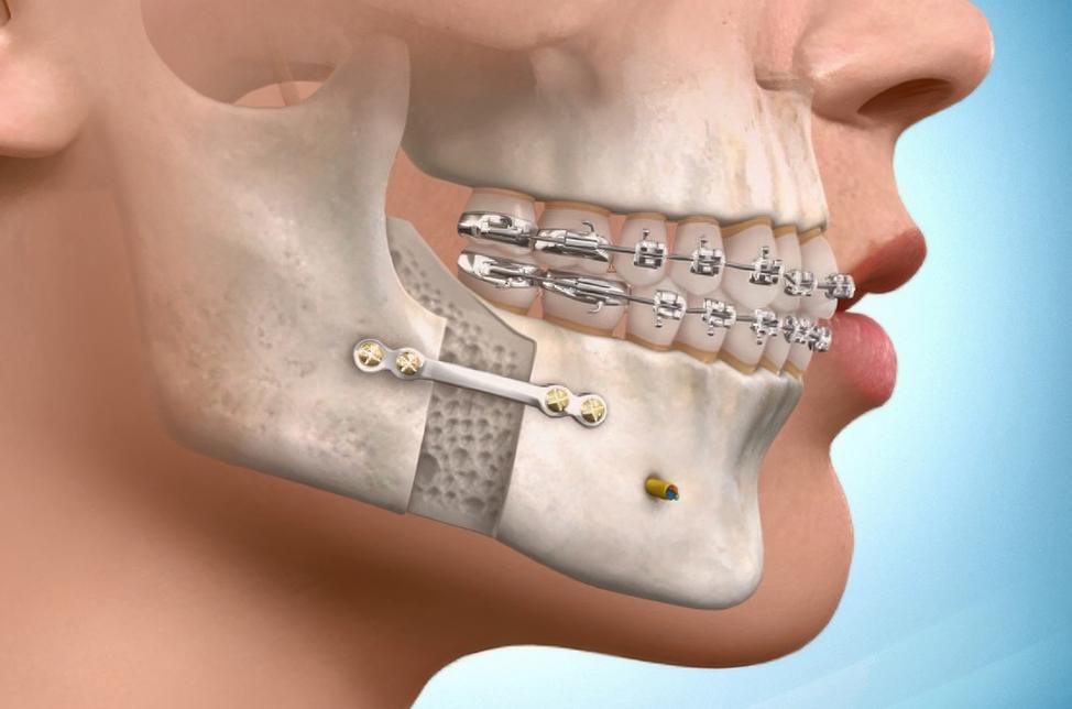 Surgical Orthodontic Treatment | North Calgary Orthodontics | Orthodontist NW Calgary