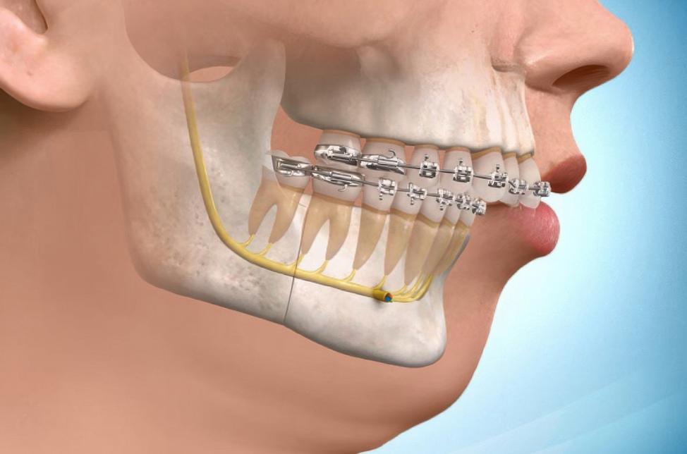 Surgical Orthodontics Service | North Calgary Orthodontics | Orthodontist Calgary